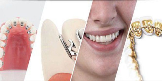 niềng răng có tác dụng gì niềng răng có tác dụng gì