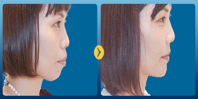 niềng răng có tác dụng gì niềng răng có tác dụng gì