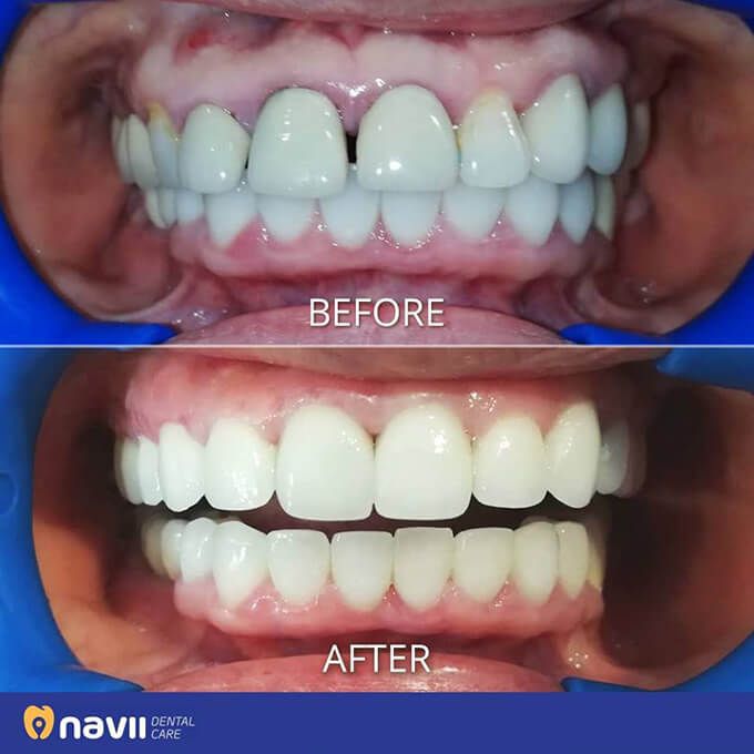 viem-loi-sau-boc-rang-su