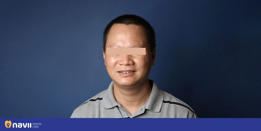 nho-rang-sau-gia-bao-nhieu