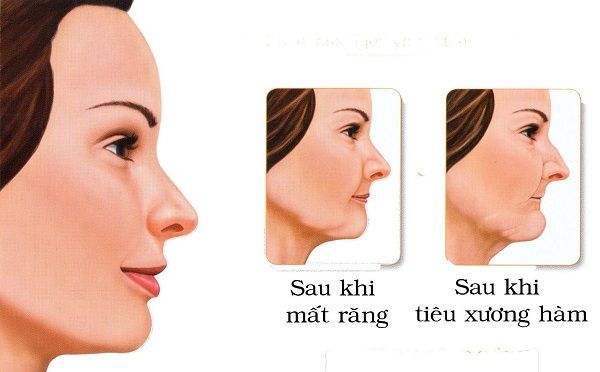 mat-rang-bao-lau-thi-bi-tieu-xuong-ham-3