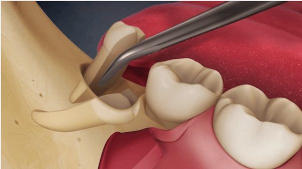 nho-rang-khon-khong-het-chan-1