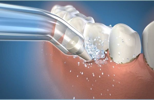Lấy cao răng là bước đầu tiên để loại bỏ sạch vi khuẩn gây trầm trọng thêm viêm nướu răng