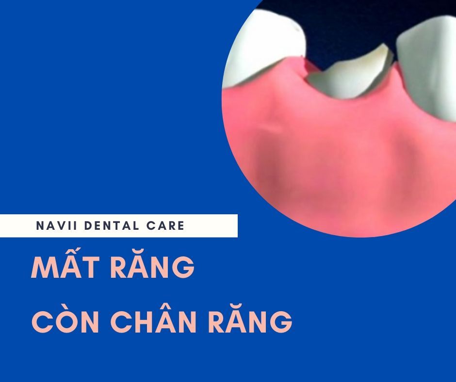 mat-rang-con-chan-rang-1