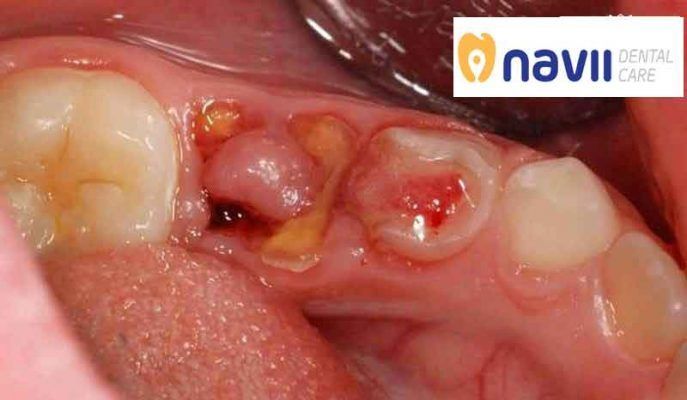 mat-rang-con-chan-rang-3