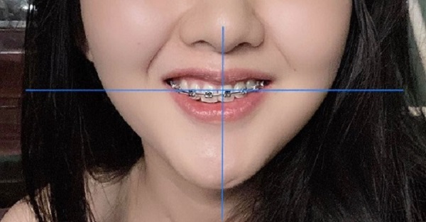 nieng-rang-xong-bi-lech-nhan-trung-1