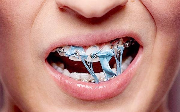 nieng-rang-xong-bi-lech-nhan-trung-2