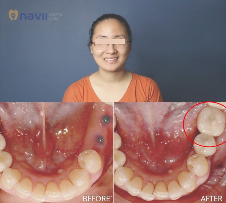 trong-rang-implant-phuc-hình-rang-da-mat