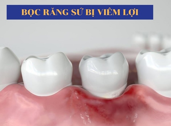 boc-rang-su-bi-viem-loi-1