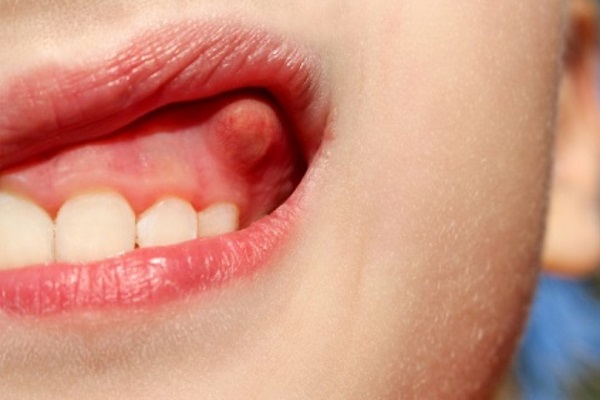 boc-rang-su-bi-viem-loi-4