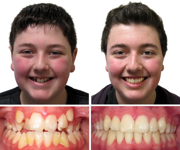 nieng-rang-co-lam-mui-cao-len-3