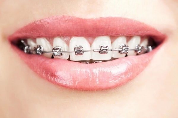 nieng-rang-khi-mang-thai-1