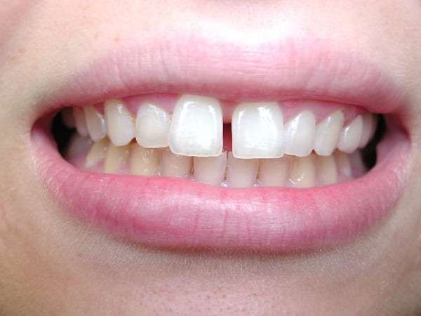 rang-thua-nen-nieng-hay-boc-su-1