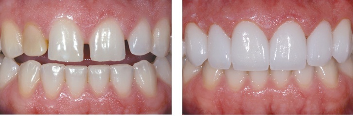 rang-thua-nen-nieng-hay-boc-su-3