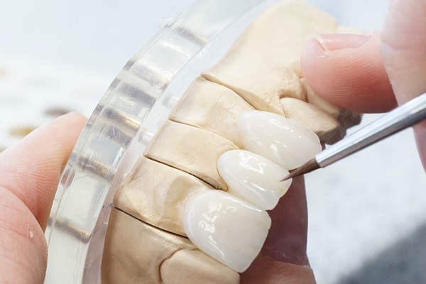 gia-tien-boc-rang-su-1