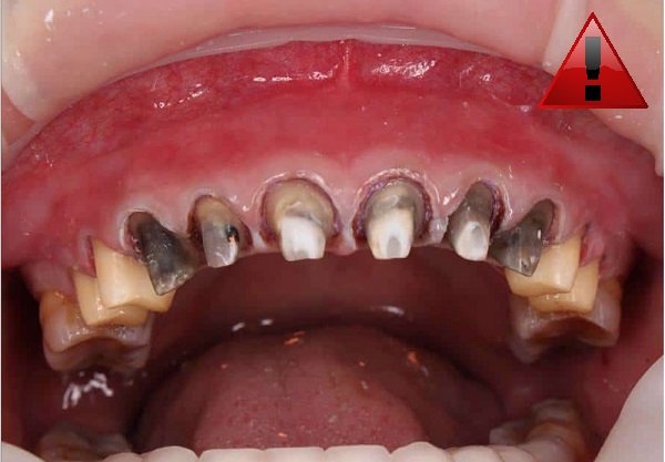 gia-tien-boc-rang-su-3