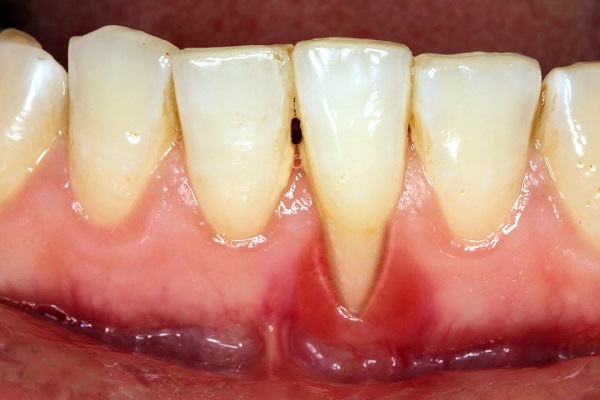 benh-ly-gay-mat-rang-2