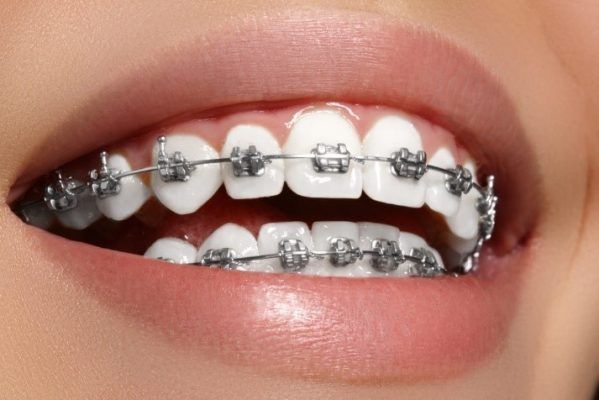 Nềng răng mắc cài kim loại tự buộc nieng-rang-mac-cai-kim-loai-tu-buoc-tao-nha-khoa-navii